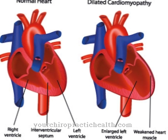 Arrhythmogenic right ventricular cardiomyopathy