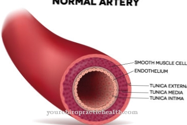 Anterior spinal artery syndrome