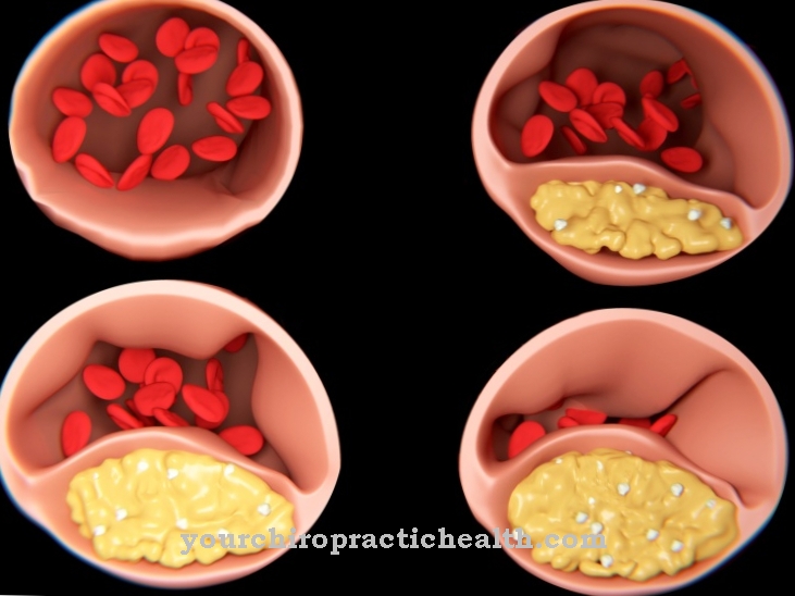 arteriosklerosis