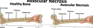 Aseptic bone necrosis