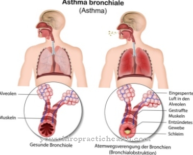 bronchial asthma