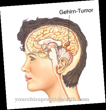 Astrocytoma (glioblastoma)