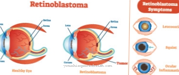 Cáncer de ojo