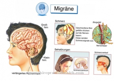 Eye migraines