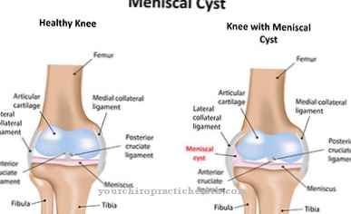 Baker's cyst