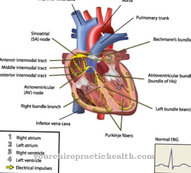 Bacterial endocarditis