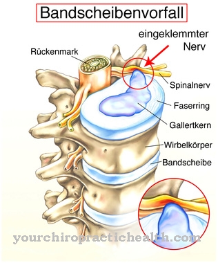 disc prolapse