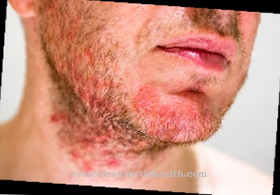 Lichene della barba (tinea barbae)