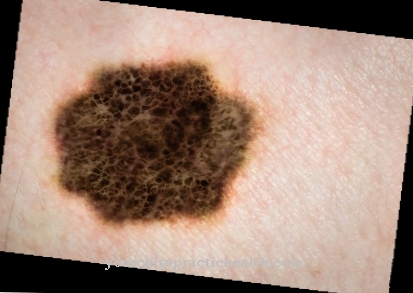 Basalioma (basal cell carcinoma)