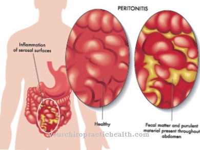 Peritonitis