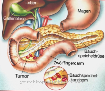 Pancreatic cancer (pancreatic cancer)