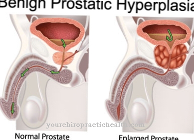 Benign prostatic hyperplasia