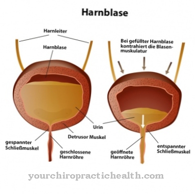 Overactive bladder (irritable bladder)