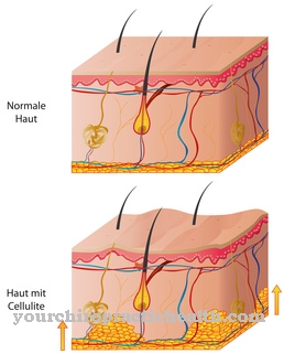 Connective tissue weakness