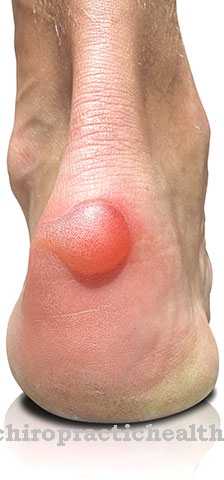 Blisters on the feet