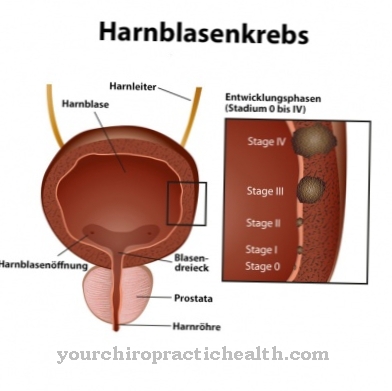 Bladder cancer