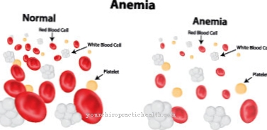 Anemia devido à falta de ácido fólico