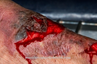 Burn wound