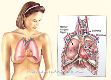 Bronchiectasis