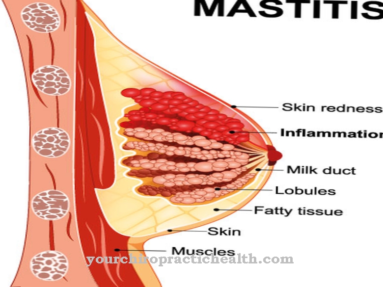 mastitida