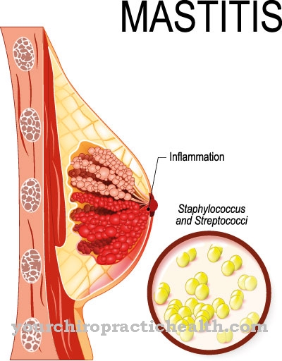 Inflamación del pezón