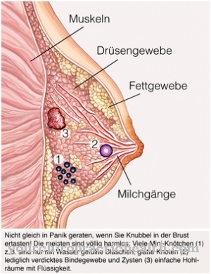 Breast cysts