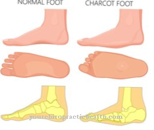 เท้า Charcot