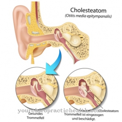 cholesteatoma