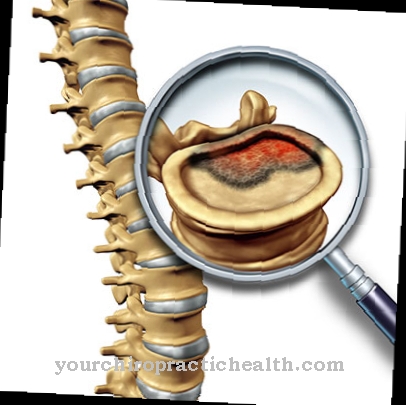 Chondroblastoma