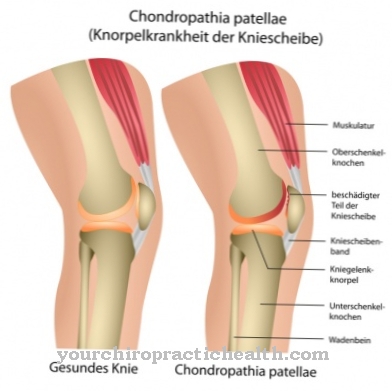 Chondropathia patellae