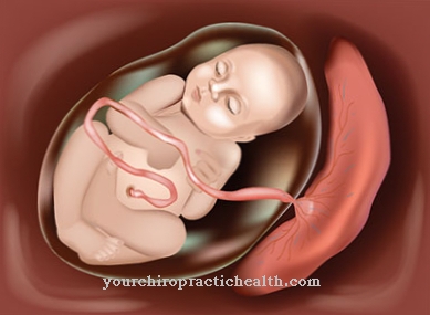 Chorionic carcinoma