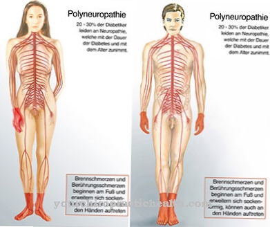 Chronische inflammatoire demyeliniserende polyneuropathie