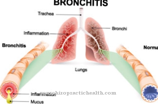 Hronisks obstruktīvs bronhīts