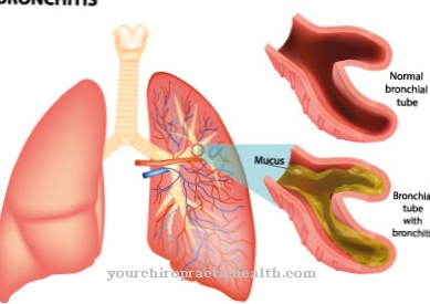 Chronic bronchitis