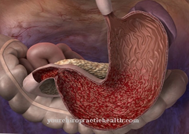 Peradangan kronis pada lapisan perut (gastritis)