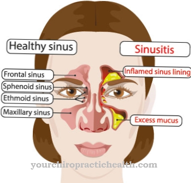 Sinusite chronique