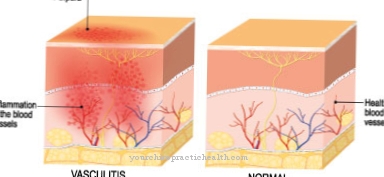 Churg-Strauss syndrome