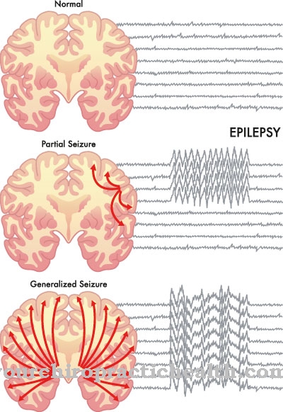 Coffin-Siris Syndrome