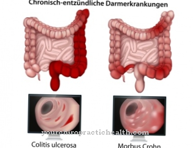 Colitis ulcerosa