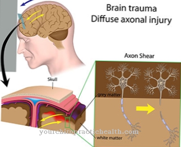 Compressio cerebri