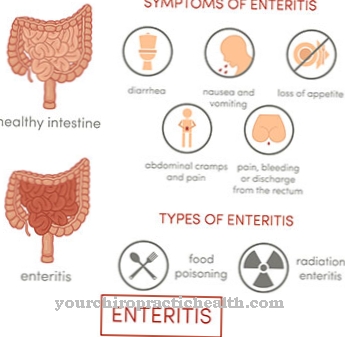 Inflammation of the intestine (enteritis)