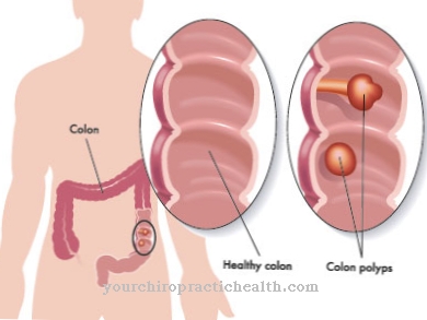 Intestinale poliepen