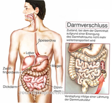 Obstruksi usus (ileus)