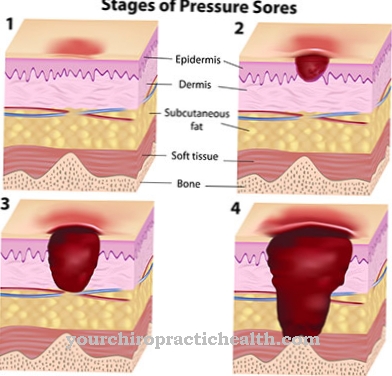 Bedsores (bedsores)