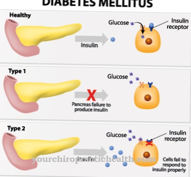 Typ 1 diabetes mellitus