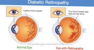 Retinopatia diabetica