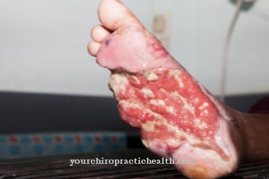 Diabetic foot syndrome