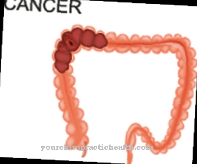 Colon cancer