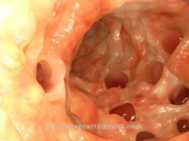 Diverticulum in the intestine (diverticulosis)