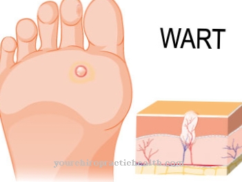 Plantar warts